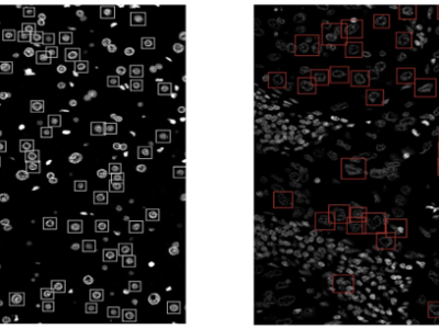 Intelligenza artificiale come supporto alla diagnosi di epatocarcinoma - Maker Faire